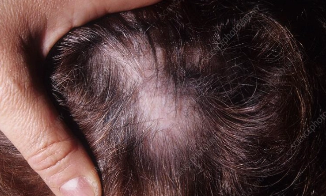 lupus diagnosis lupus diagnosis