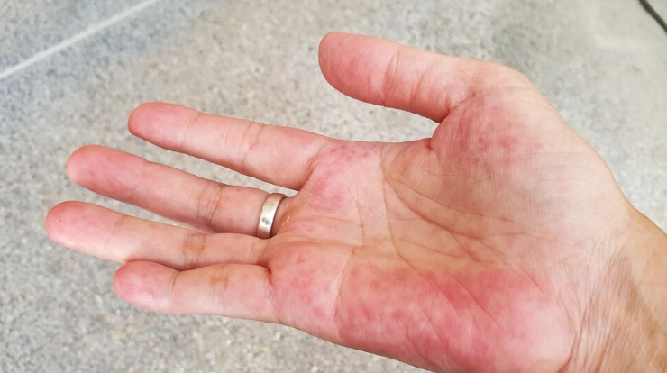 how is lupus diagnosed