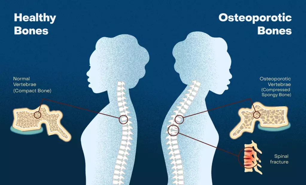 osteoporosis prevention
