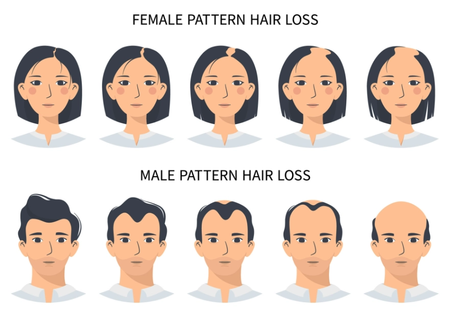 androgenetic alopecia in women