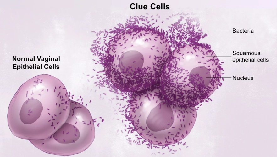 bacterial vaginosis symptoms