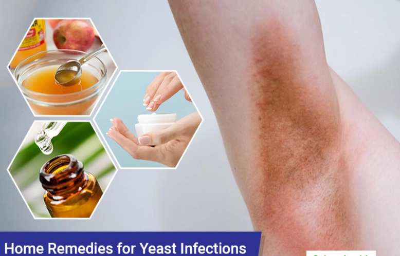 best yeast infection treatment