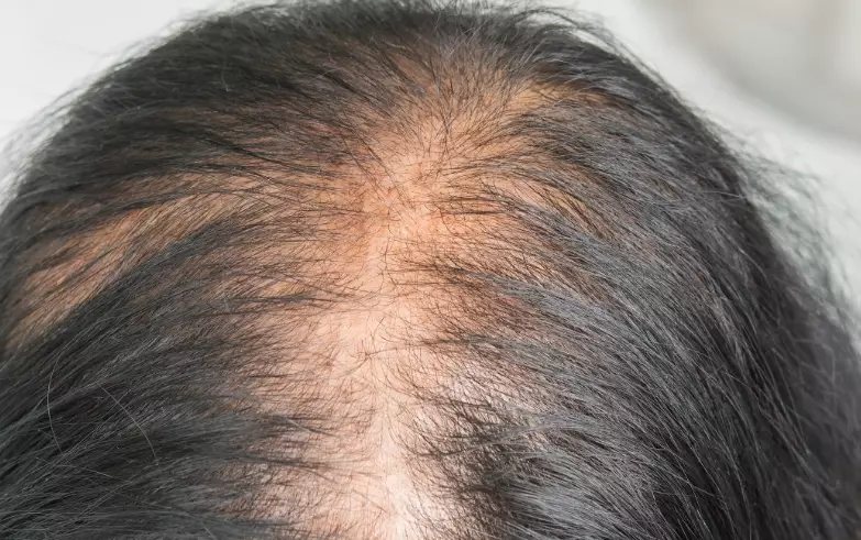 androgenetic alopecia in women