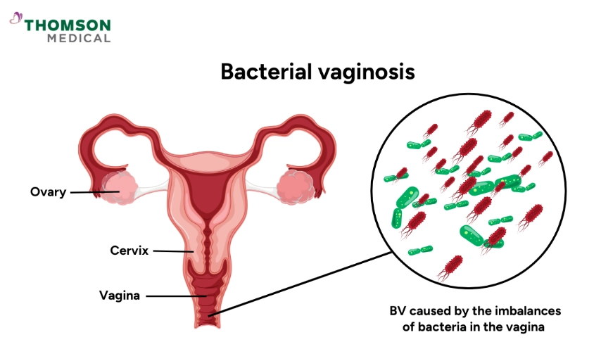 bacterial vaginosis symptoms