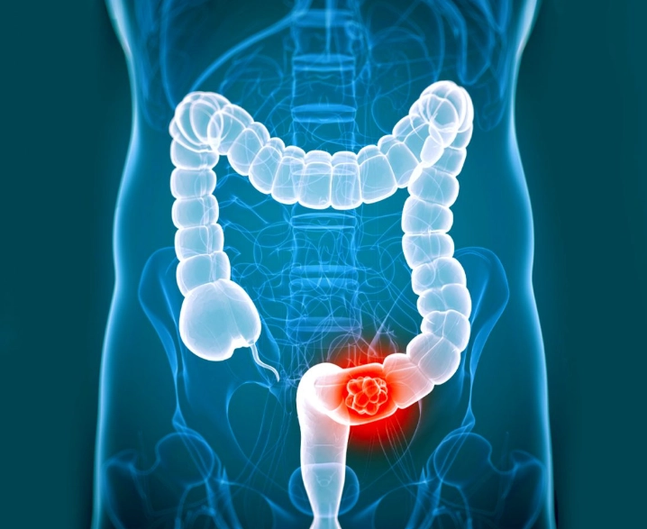colon cancer screening women