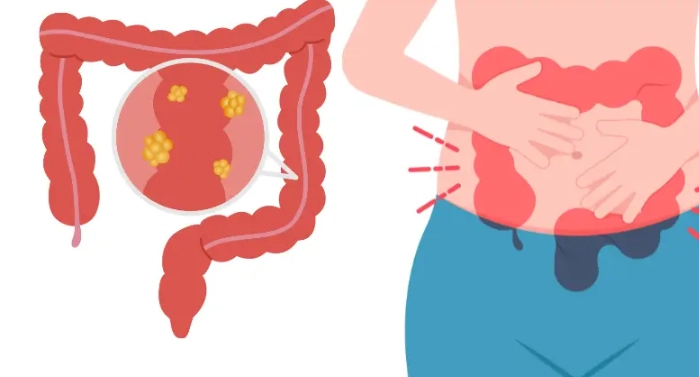 signs of colorectal cancer in females
