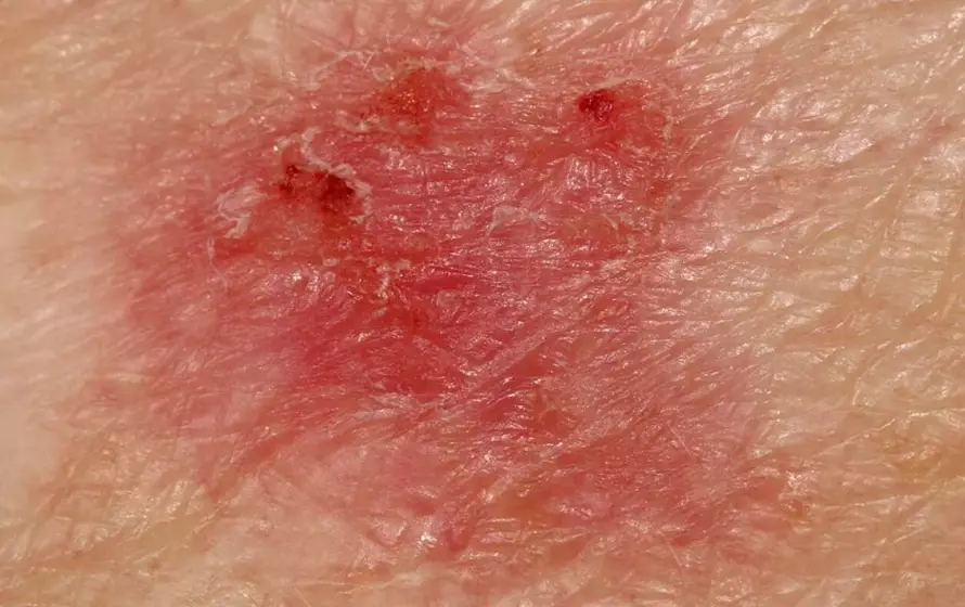 signs of skin cancer