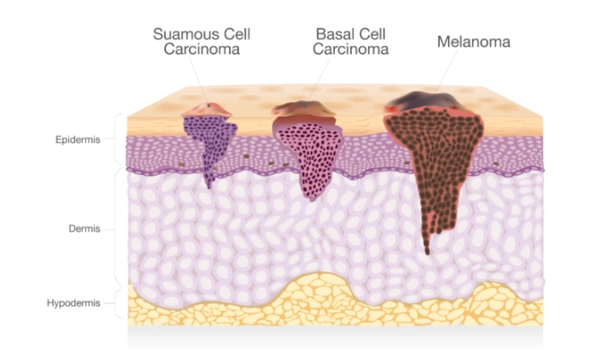 signs of skin cancer