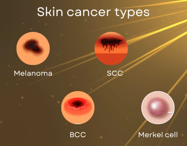 melanoma in women