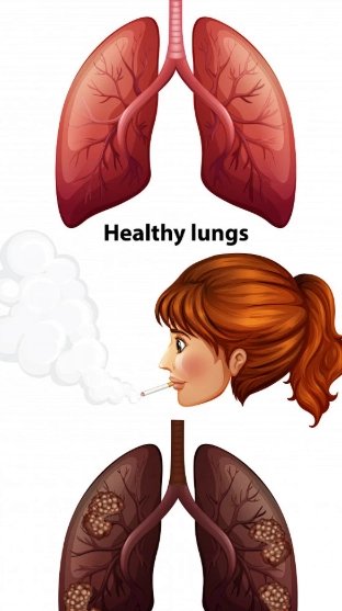 non-smoking women lung cancer