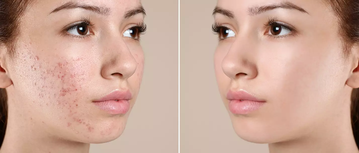 adult female acne treatment