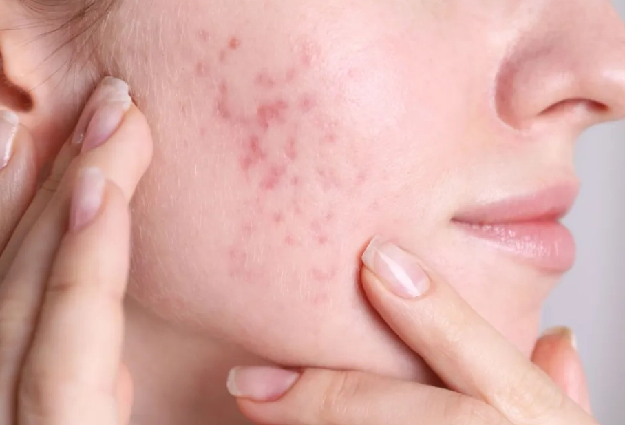 best acne products for women