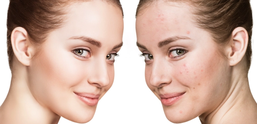 adult female acne treatment