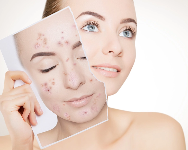 best acne products for women