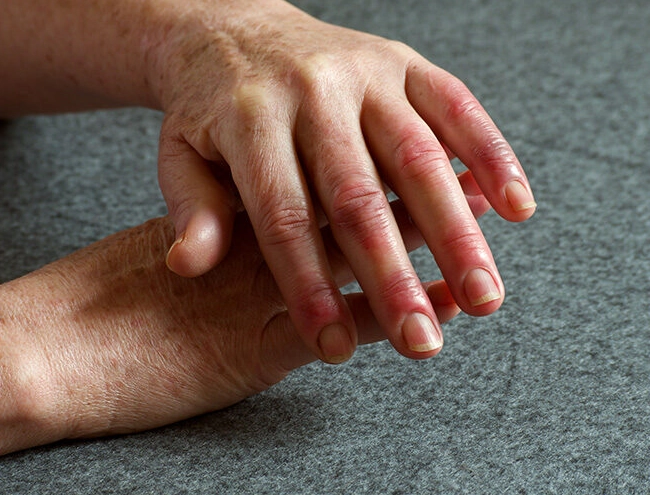 rheumatoid arthritis symptoms women