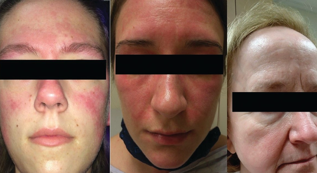 lupus symptoms women