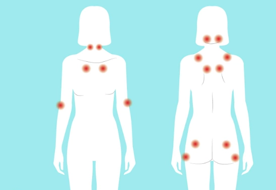 fibromyalgia symptoms in women