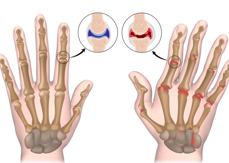 arthritis symptoms in women