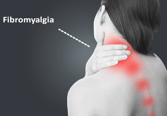 managing fibromyalgia in women