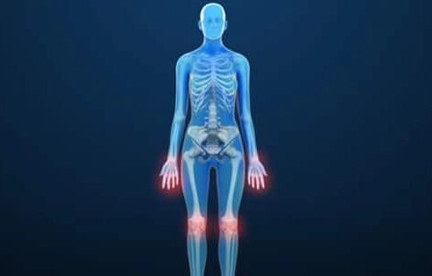 arthritis symptoms in women