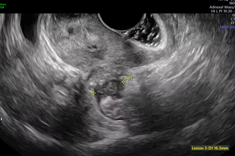 diagnosing endometriosis diagnosing endometriosis