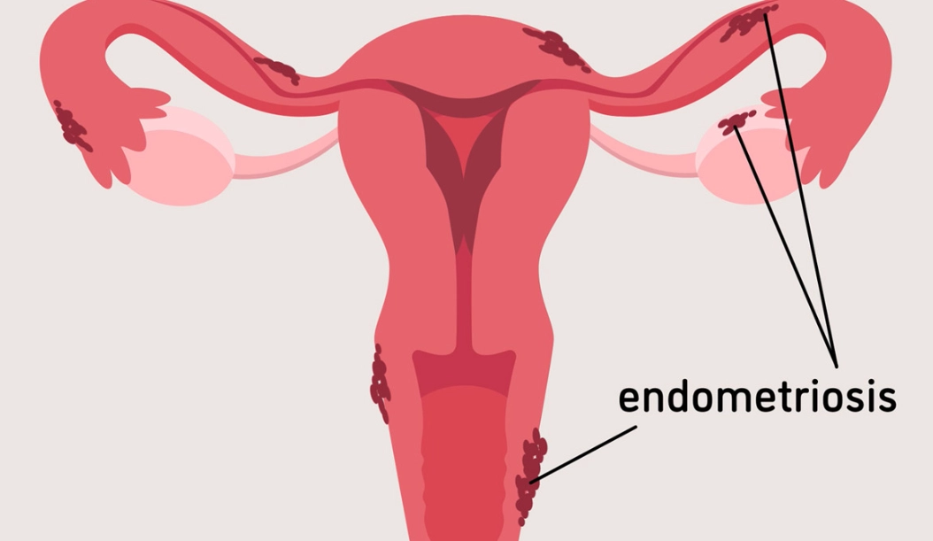 diagnosing endometriosis diagnosing endometriosis