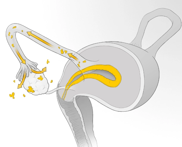 what causes endometriosis what causes endometriosis