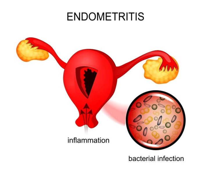 Endometriosis causes