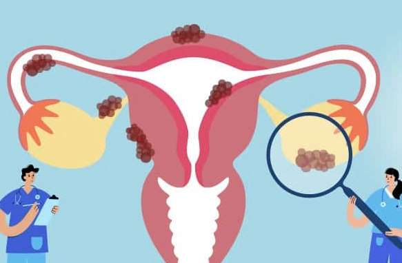 endometriosis laparoscopy endometriosis laparoscopy