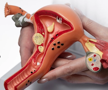 what causes endometriosis what causes endometriosis