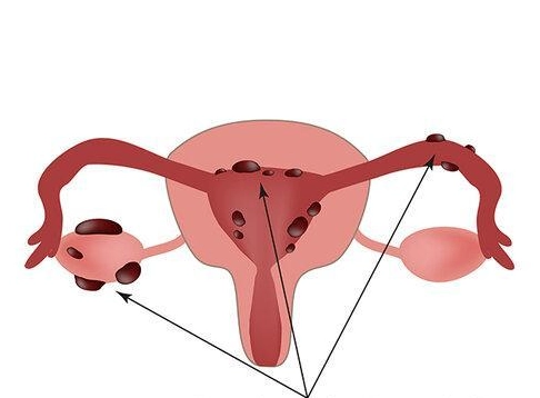 endometriosis symptoms