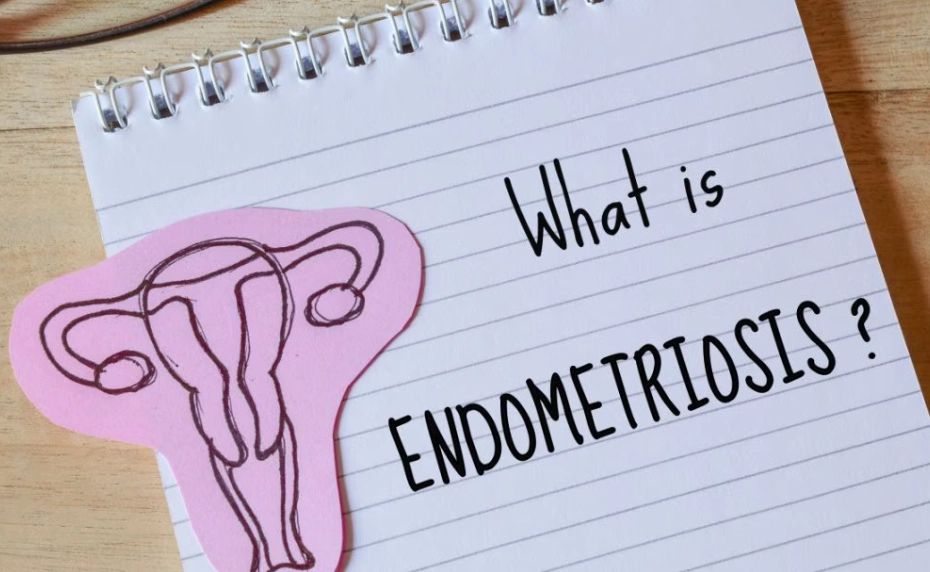 endometriosis and fertility endometriosis and fertility