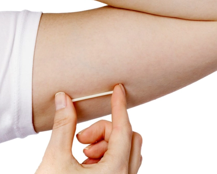 birth control implant birth control implant