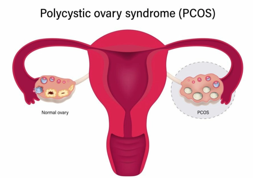 PCOS symptoms checklist