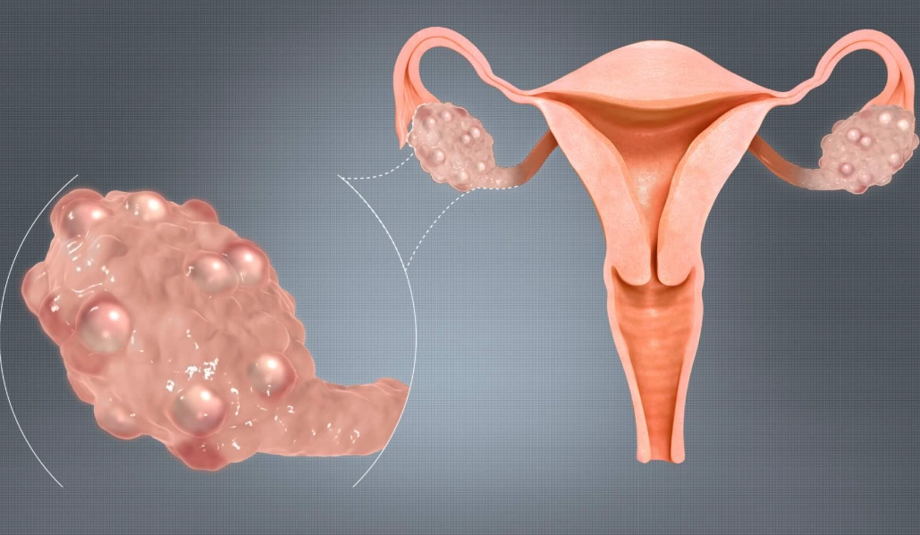 early signs of ovarian cancer