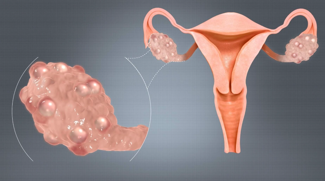 ovarian cyst symptoms