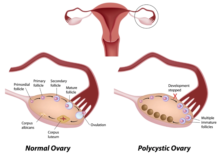 premature ovarian failure