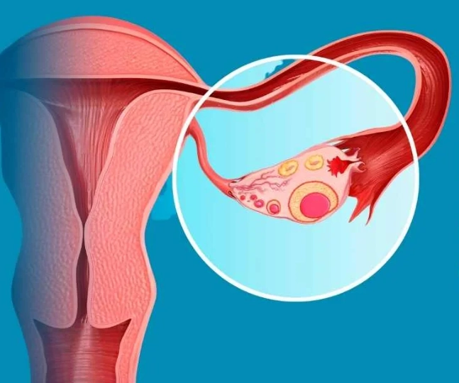 ovarian cancer symptoms ovarian cancer symptoms