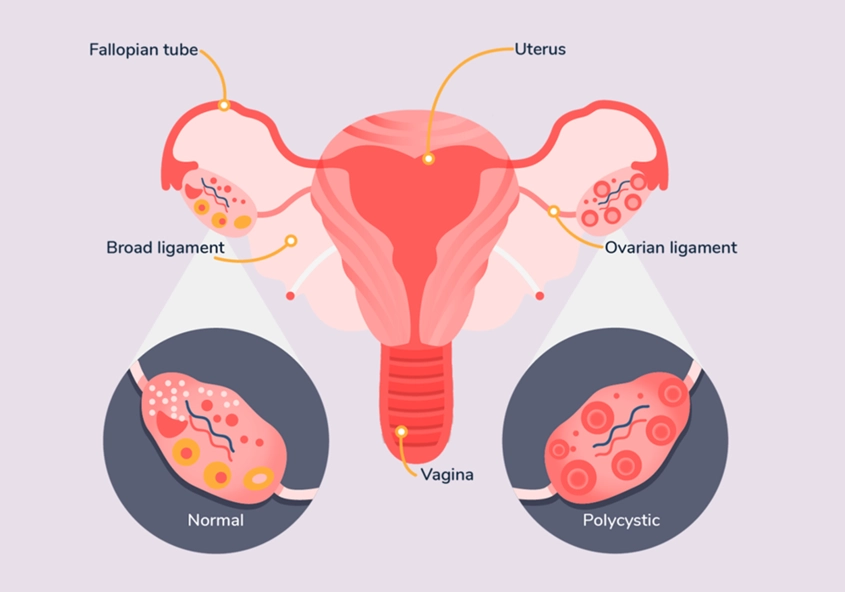 ovarian cyst symptoms