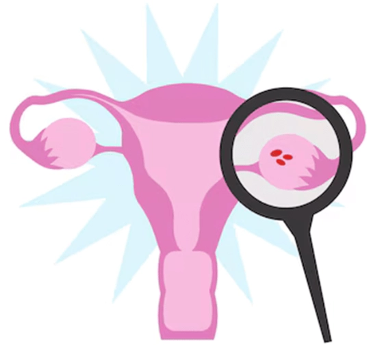 ovarian cancer symptoms ovarian cancer symptoms