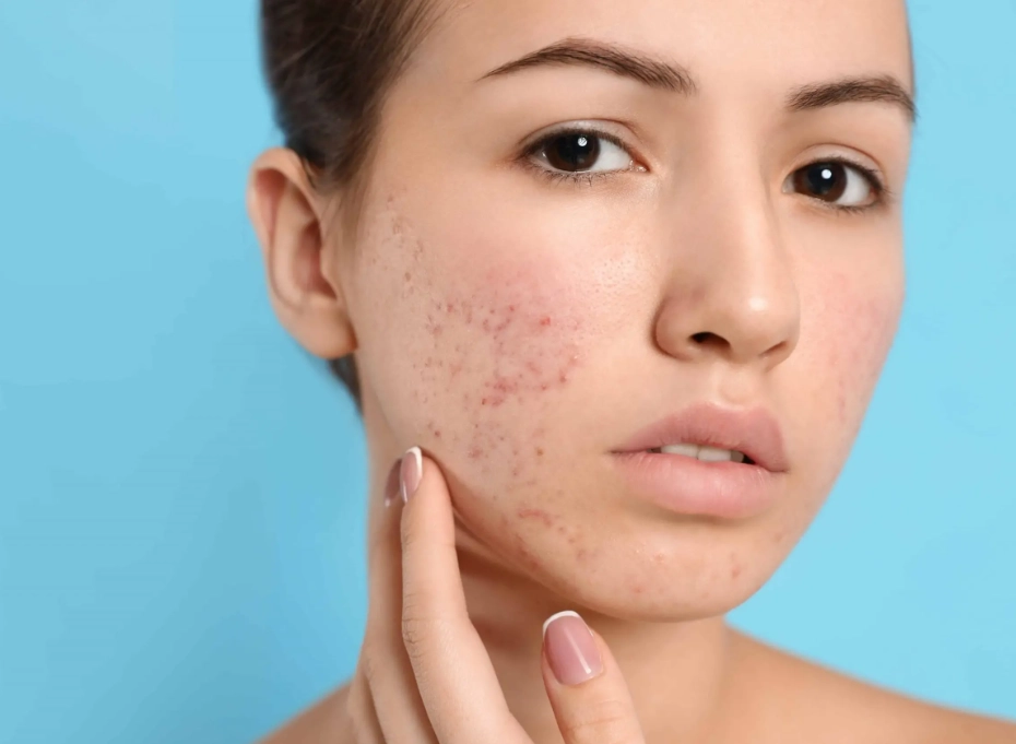 best products for acne best products for acne