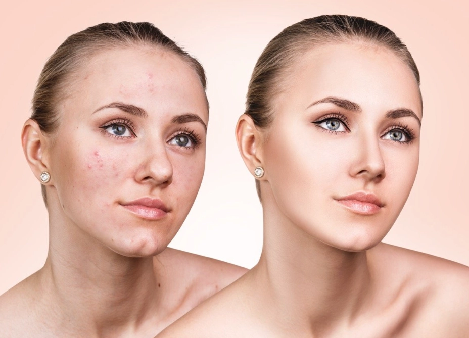 acne treatment routine acne treatment routine